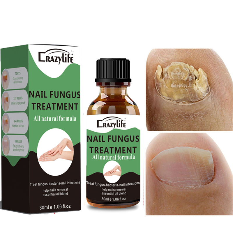 Crazylife Extra Strong Nail Fungus Treatment Serum Essence oil Repair Removal Fungal Feet Nails Care Toe Anti Infection Cream Essence