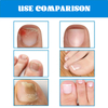 Crazylife 28Pcs Toenail Fungus Patch Nail Repair Patches Nail Ingrown Correction Sticker Discolored Damaged Nails Foot Care Tool Uñas