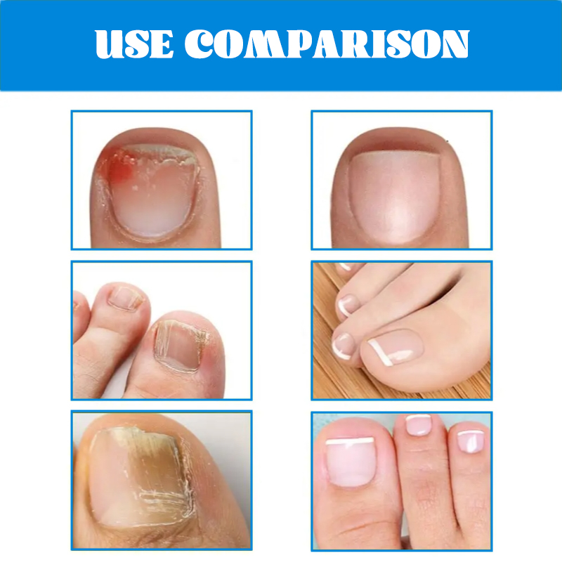 Crazylife 28Pcs Toenail Fungus Patch Nail Repair Patches Nail Ingrown Correction Sticker Discolored Damaged Nails Foot Care Tool Uñas