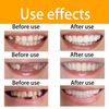 Crazylife Professional Temporary Clip-On Veneers / Dental Veneers Kit - Cosmetic Instant Smile Makeover, Stain-Resistant & Removable False Teeth Covers 