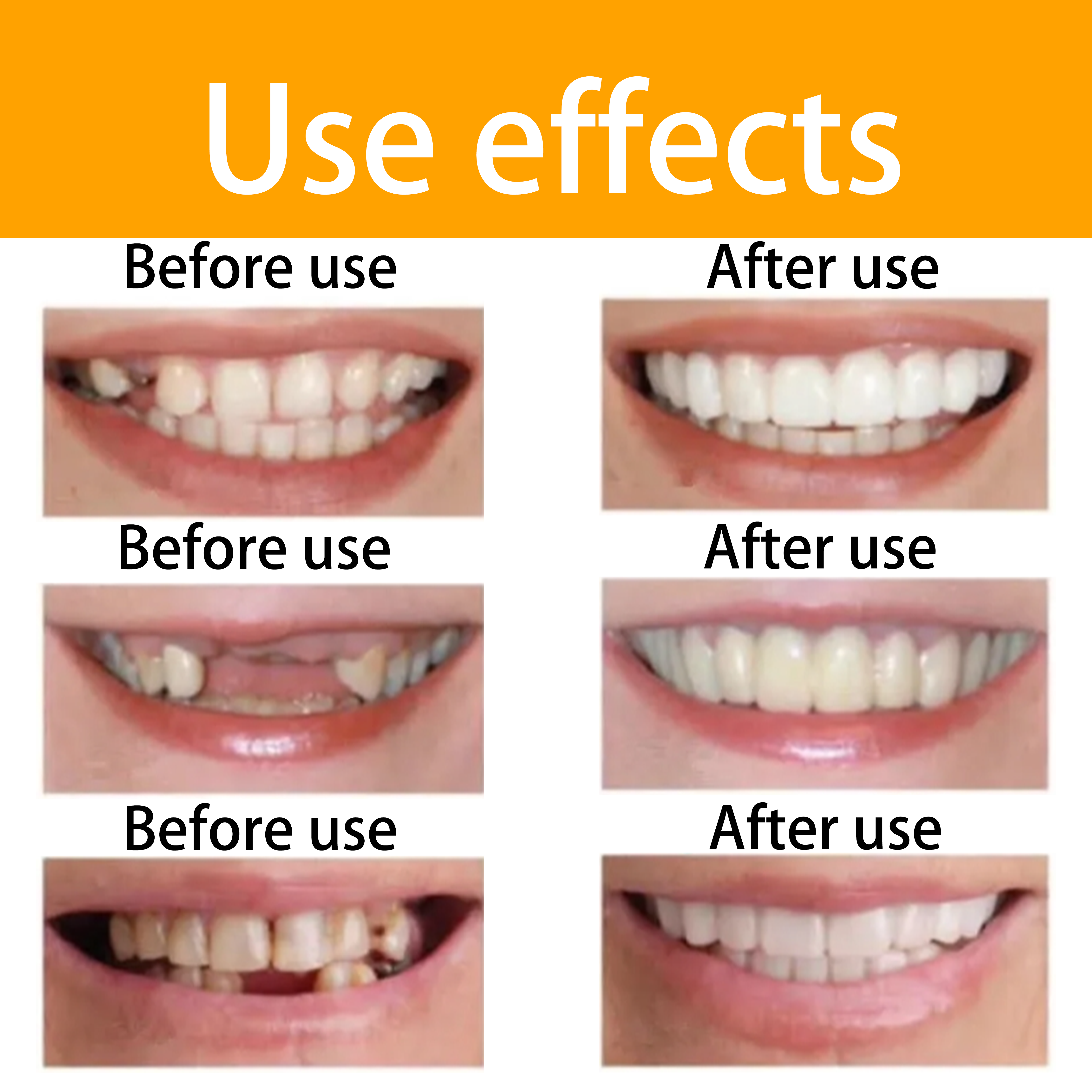 Crazylife Professional Temporary Clip-On Veneers / Dental Veneers Kit - Cosmetic Instant Smile Makeover, Stain-Resistant & Removable False Teeth Covers 