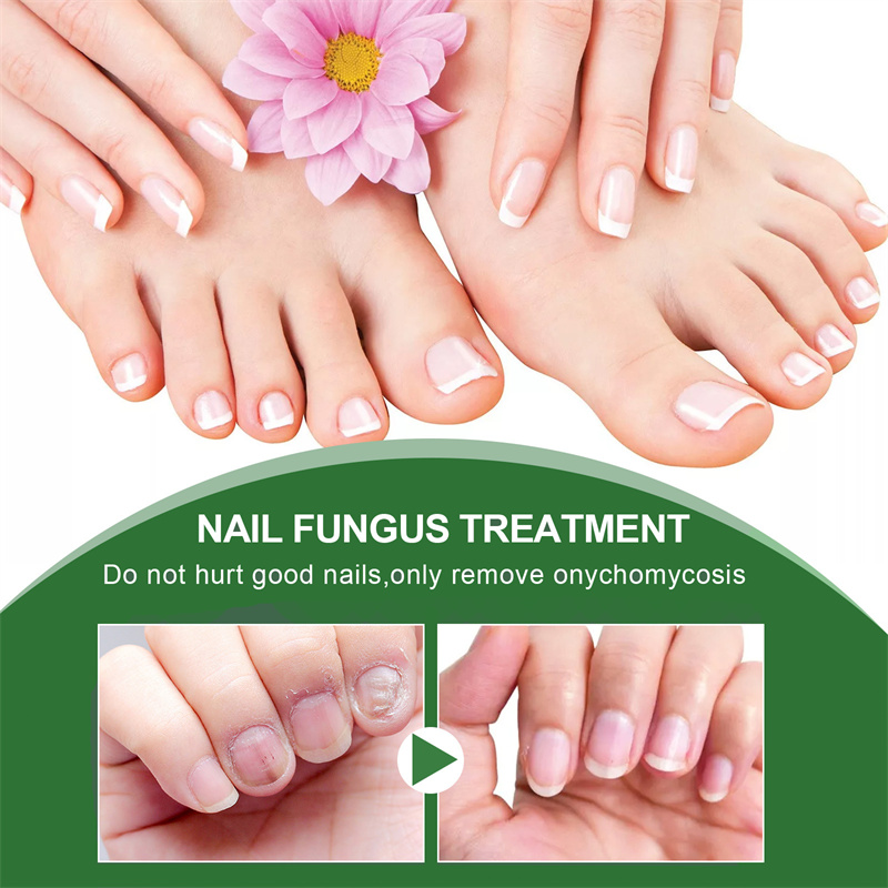 Crazylife Extra Strong Nail Fungus Treatment Serum Essence oil Repair Removal Fungal Feet Nails Care Toe Anti Infection Cream Essence