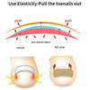 Tonfly Ingrown Toenail Correction Tool Nail Filling Pad Ingrown Toe Nail Treatment Elastic Patch Straightening Clip Brace Pedicure Tool