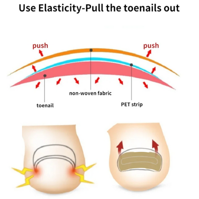 Tonfly Ingrown Toenail Correction Tool Nail Filling Pad Ingrown Toe Nail Treatment Elastic Patch Straightening Clip Brace Pedicure Tool
