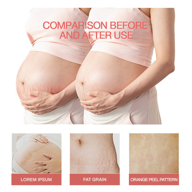StretchMarkCreamNATURALFORMULA - Natural formula oil for reducing and smoothing pregnancy stretch marks, providing firming effect.