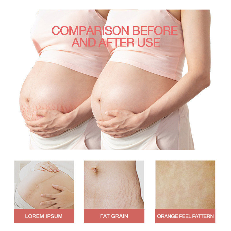 StretchMarkCreamNATURALFORMULA - Natural formula oil for reducing and smoothing pregnancy stretch marks, providing firming effect.
