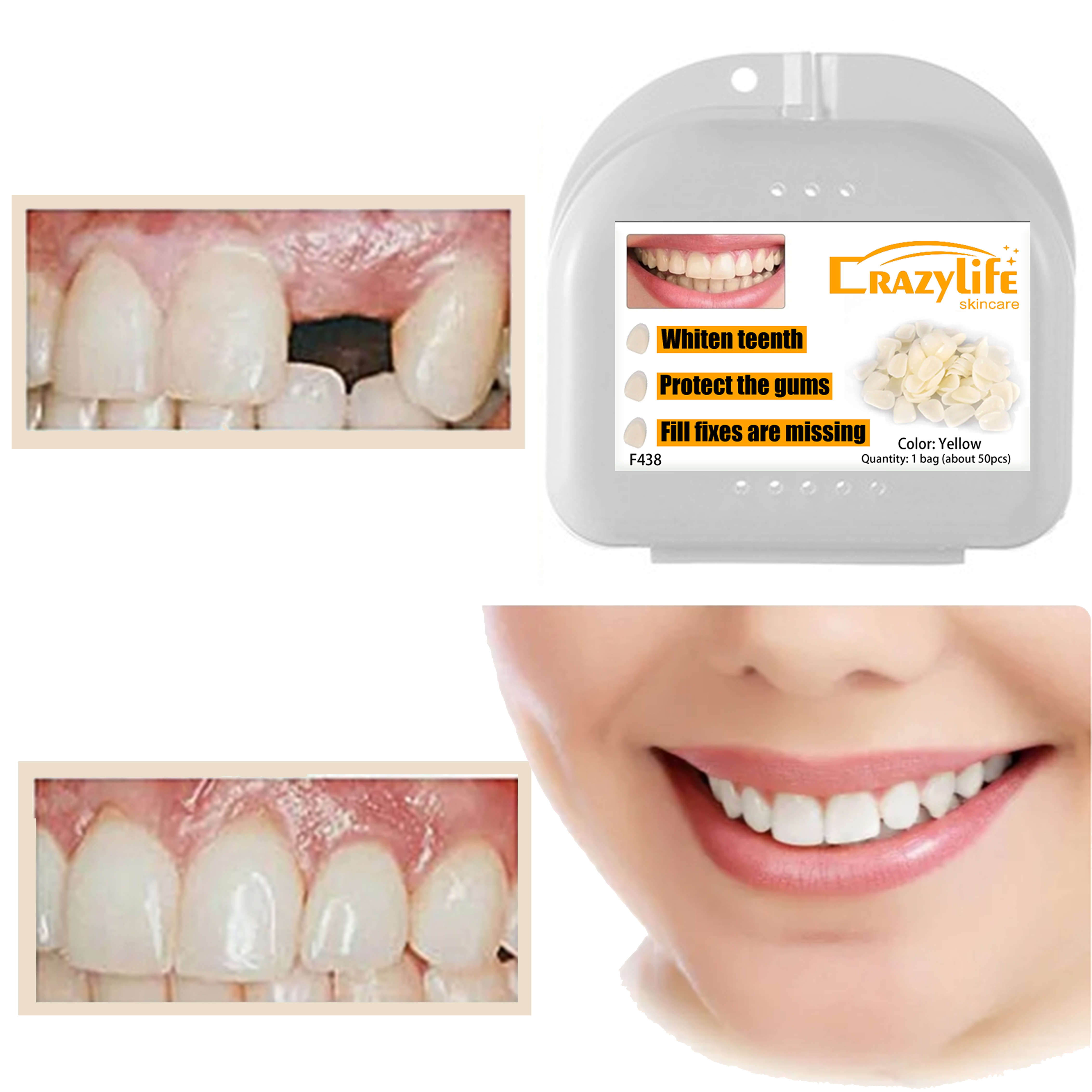 Crazylife Professional Temporary Clip-On Veneers / Dental Veneers Kit - Cosmetic Instant Smile Makeover, Stain-Resistant & Removable False Teeth Covers 