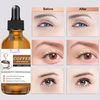 Eye Care 30ml Eye Fat Removal Serum Effective Anti-Particles Eye Cicle Line Fine Fade Improve Serum Care Puffiness Dark 