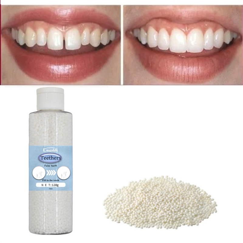 Crazylife Dental Repair Kit Temporary Tooth Filling - Instant Pain Relief for Cracked Tooth, Cavities, Lost Filling & Gaps | Strong Putty for Dentures, Crowns & Loose Teeth | Emergency Repair Solution