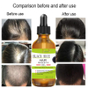 Hair Growth Serum Black Rice Rosemary for Hair Loss Treatment Bald Head Hair Regrowth Black Sesame Seeds Essence 30ml