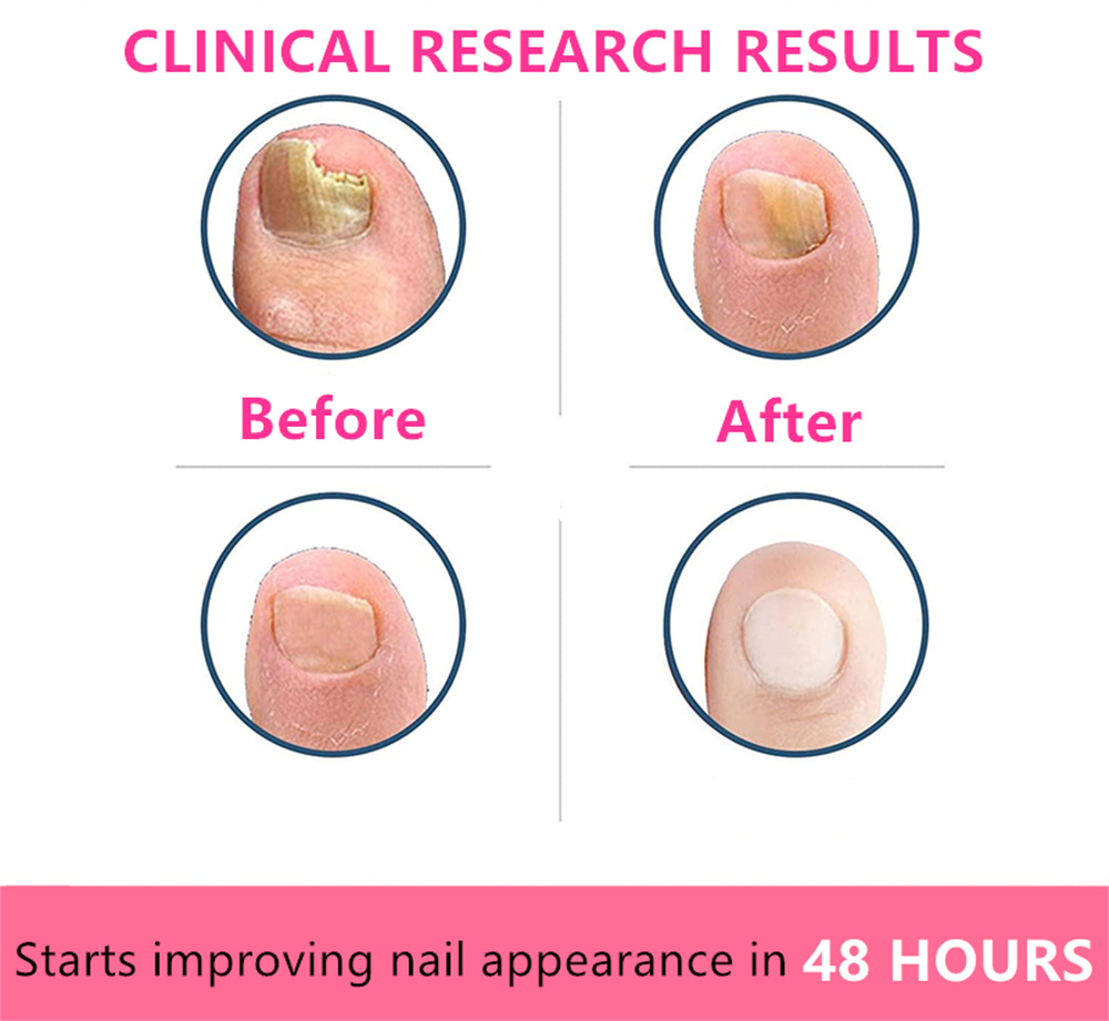 Blsex Nail Fungal Repair Serum Foot Toe Nail Fungus Removal Essential Oil Anti Infection Onychomycosis Paronychia Repairing Care