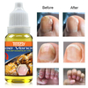 Tonfly Uñas Fungus Nails Treatment for Fingernails Toenails Repair Onychomycosis Paronychia Anti Infection Toe Nail Fungal Removal 