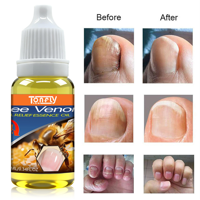 Tonfly Uñas Fungus Nails Treatment for Fingernails Toenails Repair Onychomycosis Paronychia Anti Infection Toe Nail Fungal Removal 