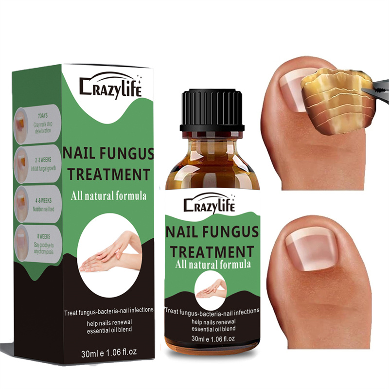 Crazylife Extra Strong Nail Fungus Treatment Serum Essence oil Repair Removal Fungal Feet Nails Care Toe Anti Infection Cream Essence