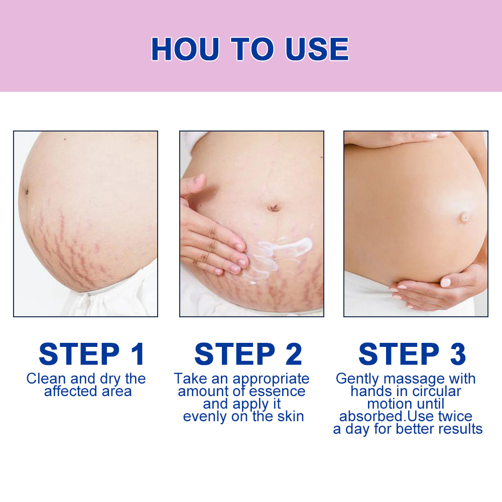 Cross-border stretch mark care cream - Body texture scar post-pregnancy care massage cream